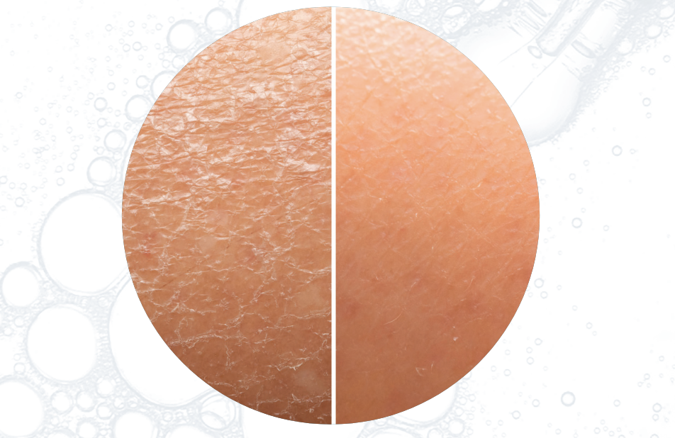 LaDonna Kosmetik Rottenburg - Fruchtsäure-Peeling